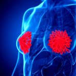 Breast cancer treatment breakthrough as Pfizer and Arvinas advance first oral PROTAC therapy to Phase III trials, opening path for protein degradation drugs